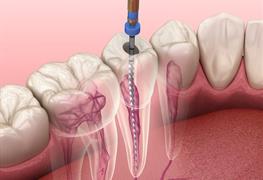 ترمیم و عصب کشی دندان